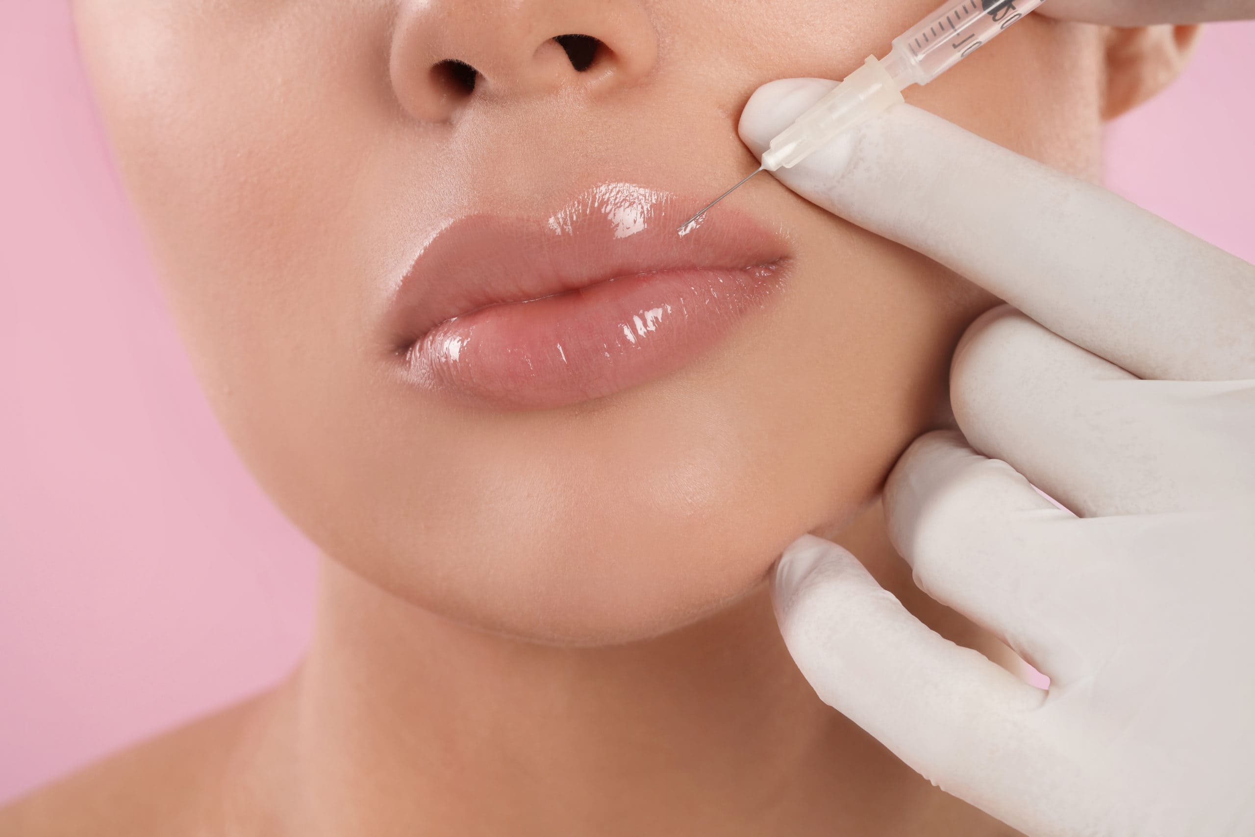Lip Filler – Aumento y Perfilado de Labios