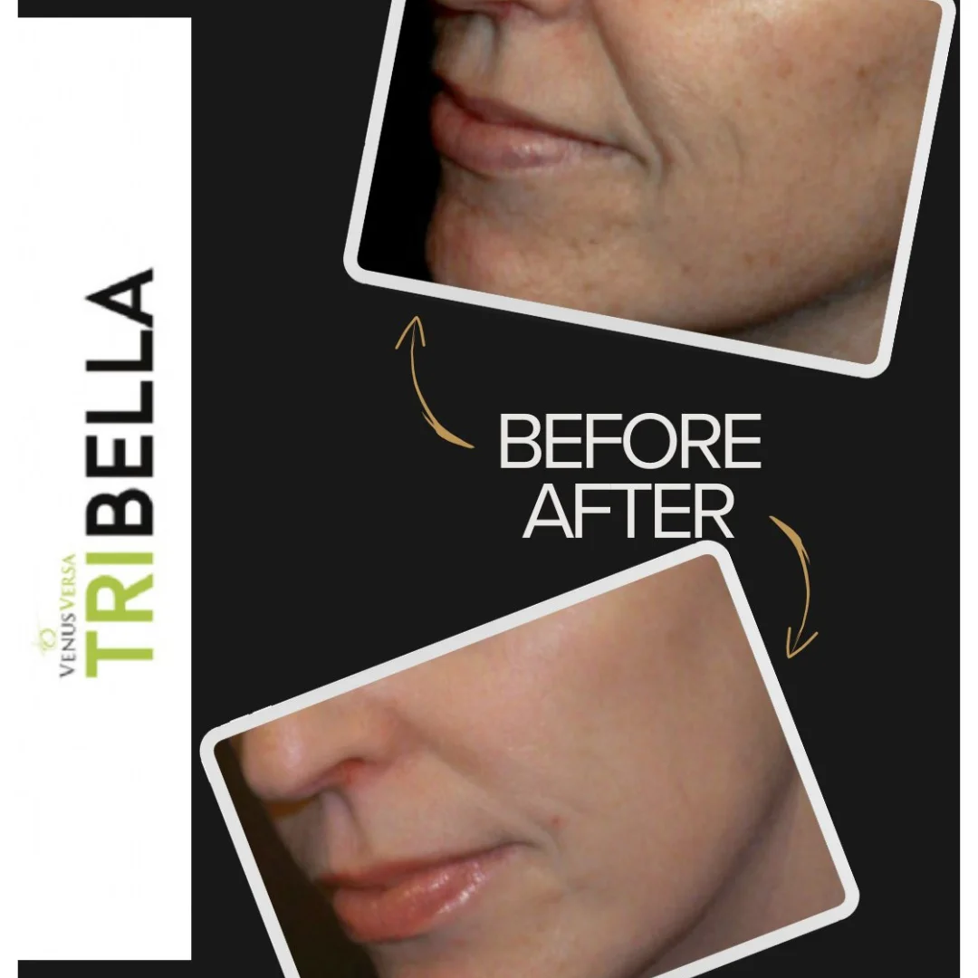 ADN de Salmón + Exosomas con TriBella™ Venus Versa Pro