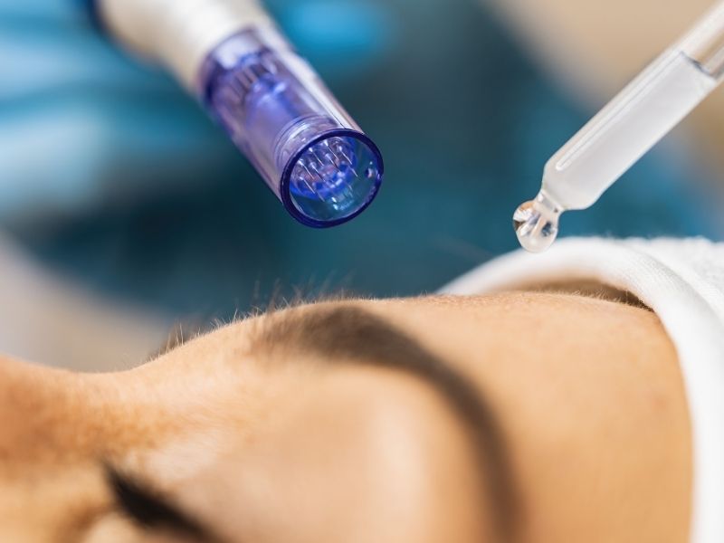 Exosomas con Microneedling