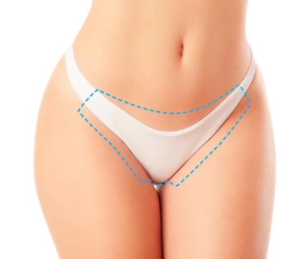 Depilación Láser Bikini Brasileño Plus – Venus Velocity